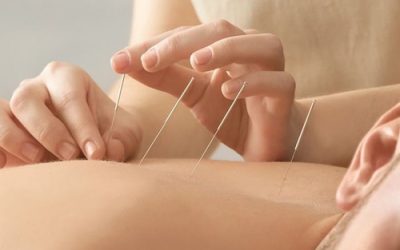 Dry Needling