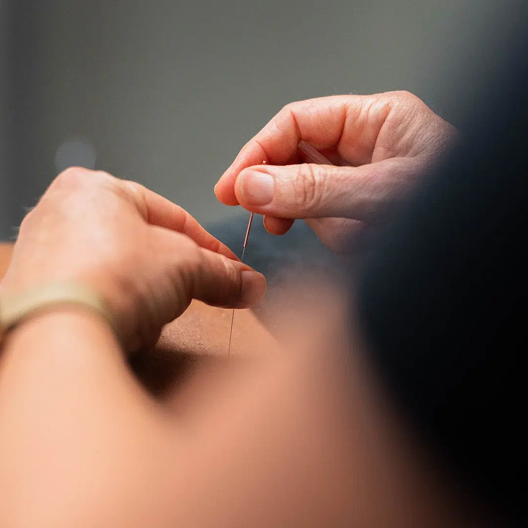 Needling - How We Use Dry Needling at Studio 4 Dry Needling