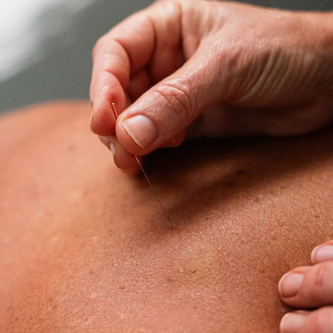 Needling - What Dry Needling Involves Dry Needling