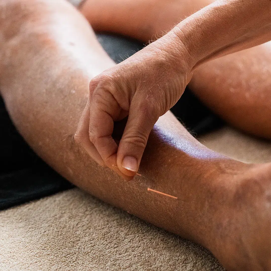 Needling - What to Expect in a Session Dry Needling
